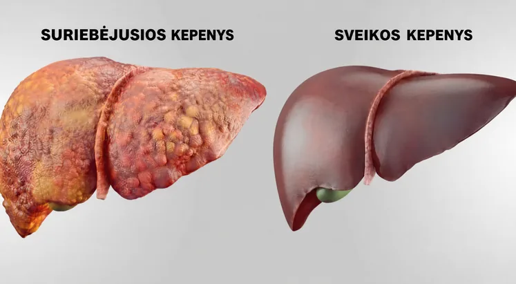Suriebėjusios kepenys šalia sveikų kepenų